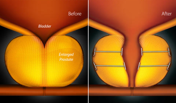urolift-img