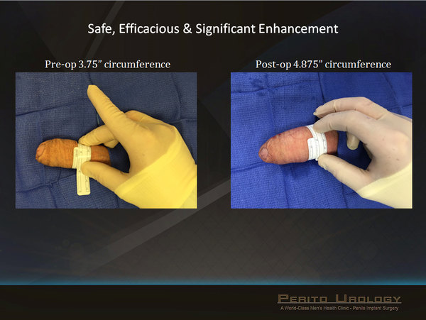 Before and After Girth Enhancement