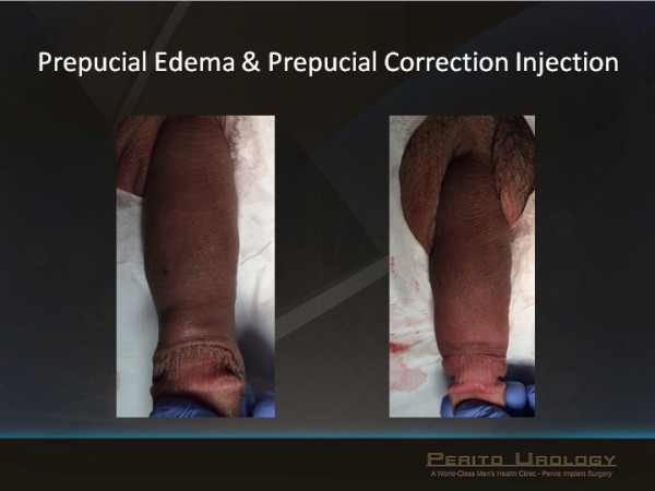 prepucial