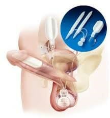 inflatable penile implant