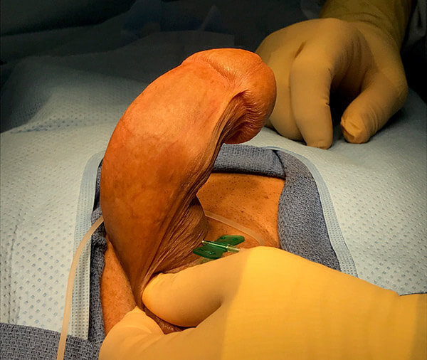 Peyronie's disease