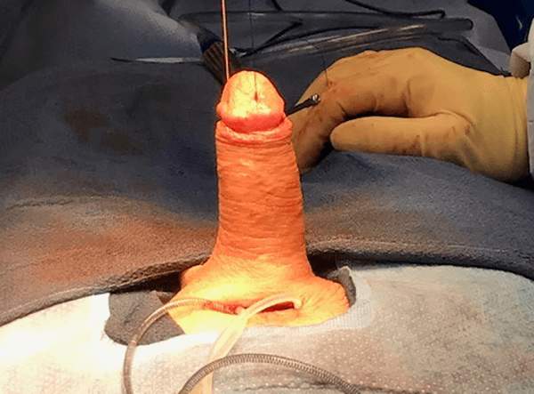 Peyronie's disease post-implant using "scratch" technique