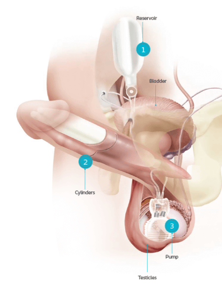 Inflatable penile implant