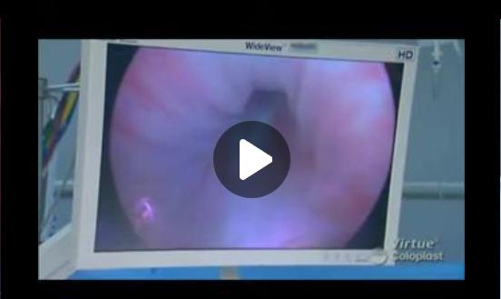 Virtue Male Sling Procedure